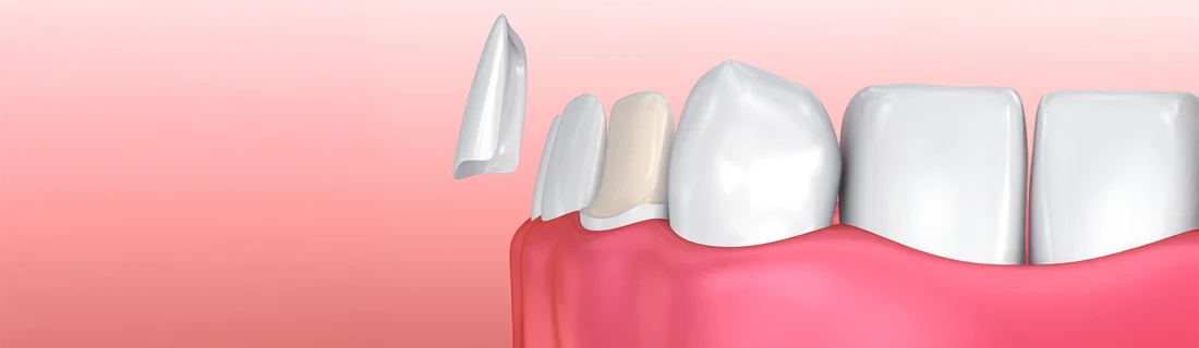 Dentist-Wheaton-IL-Dentist-Veneers Dentist-Wheaton-IL-Dentist-Veneers
